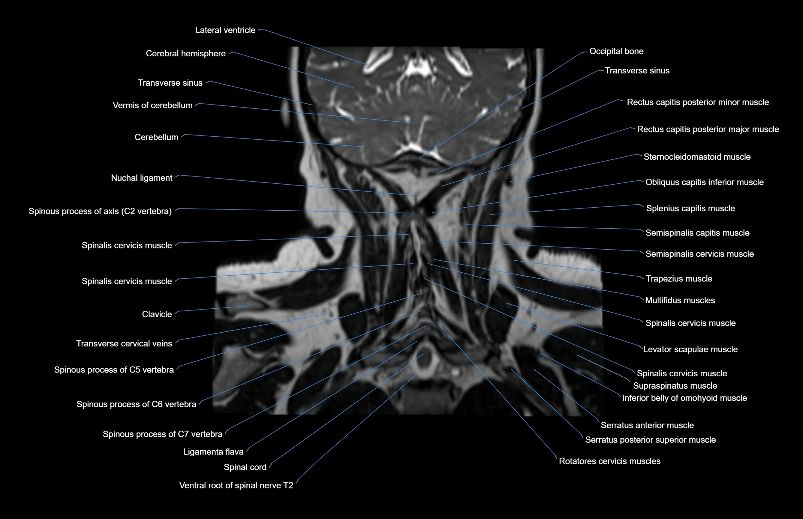 Neck coronal cross sectional MRI anatomy 3T MRI  image-img-00001-00014.webp